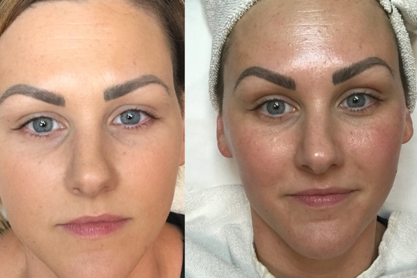 Dermaplaning