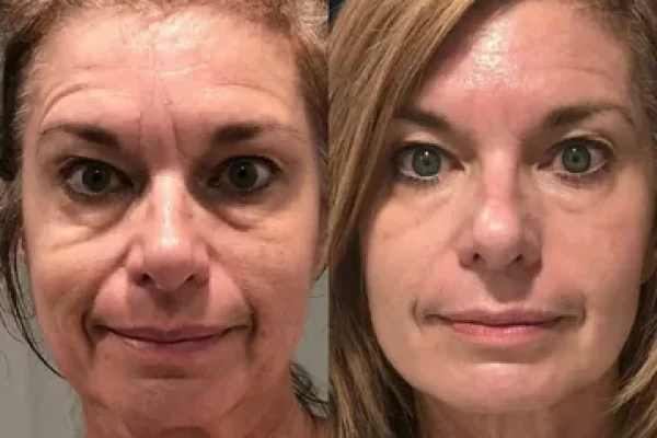HIFU Skin Tightening​