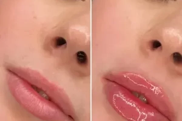 Lip Filler